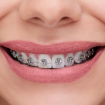 BRACKETS METAL AUTOLIGANTE ROTH U-CLIP KIT -  ORTHOMETRIC - Imagen 5
